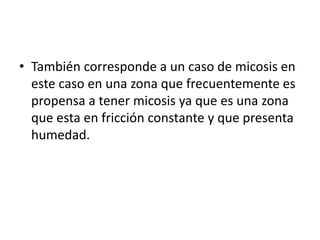• También corresponde a un caso de micosis en 
este caso en una zona que frecuentemente es 
propensa a tener micosis ya que es una zona 
que esta en fricción constante y que presenta 
humedad. 
 