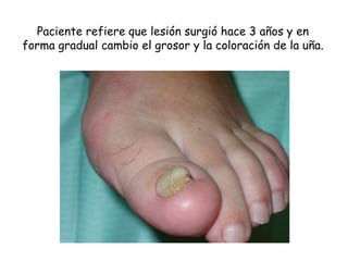 Paciente refiere que lesión surgió hace 3 años y en 
forma gradual cambio el grosor y la coloración de la uña. 
 