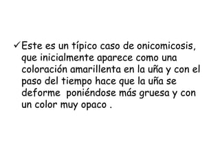 Este es un típico caso de onicomicosis, 
que inicialmente aparece como una 
coloración amarillenta en la uña y con el 
paso del tiempo hace que la uña se 
deforme poniéndose más gruesa y con 
un color muy opaco . 
 