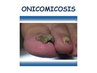 ONICOMICOSIS 
