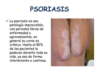PSORIASIS 
 La psoriasis es una 
patología imprevisible, 
con periodos libres de 
enfermedad y 
agravamientos, en 
general su curso es 
crónico. Hasta el 80% 
de los pacientes la 
padecen durante toda su 
vida, ya sea de forma 
intermitente o continua. 
 