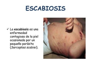 ESCABIOSIS 
 La escabiosis es una 
enfermedad 
contagiosa de la piel 
ocasionada por un 
pequeño parásito 
(Sarcoptes scabiei). 
 