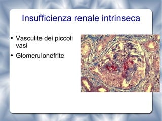 Insufficienza renale intrinseca Vasculite dei piccoli vasi Glomerulonefrite 