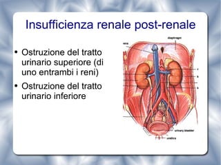 Insufficienza renale post-renale Ostruzione del tratto urinario superiore (di uno entrambi i reni) Ostruzione del tratto urinario inferiore 