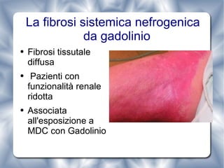 La fibrosi sistemica nefrogenica da gadolinio Fibrosi tissutale diffusa Pazienti con funzionalità renale ridotta Associata all'esposizione a MDC con Gadolinio 