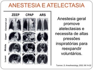 ANESTESIA E ATELECTASIA

               Anestesia geral
                  promove
                atelectasias e
              necessita de altas
                  pressões
              inspiratórias para
                 reexpandir
                 voluntários.

              Tusman, G. Anesthesiology, 2003; 98:14-22
 