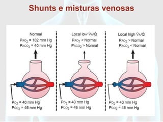Shunts e misturas venosas
 
