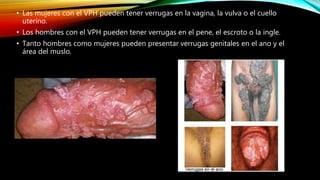 • Las mujeres con el VPH pueden tener verrugas en la vagina, la vulva o el cuello
uterino.
• Los hombres con el VPH pueden tener verrugas en el pene, el escroto o la ingle.
• Tanto hombres como mujeres pueden presentar verrugas genitales en el ano y el
área del muslo.
 