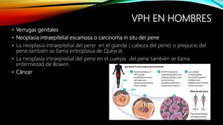 VPH EN HOMBRES
• Verrugas genitales
• Neoplasia intraepitelial escamosa o carcinoma in situ del pene
• La neoplasia intraepitelial del pene en el glande ( cabeza del pene) o prepucio del
pene también se llama eritroplasia de Queyrat.
• La neoplasia intraepitelial del pene en el cuerpo del pene también se llama
enfermedad de Bowen.
• Cáncer
 