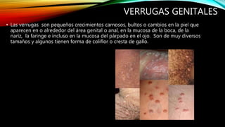 VERRUGAS GENITALES
• Las verrugas son pequeños crecimientos carnosos, bultos o cambios en la piel que
aparecen en o alrededor del área genital o anal, en la mucosa de la boca, de la
nariz, la faringe e incluso en la mucosa del párpado en el ojo. Son de muy diversos
tamaños y algunos tienen forma de coliflor o cresta de gallo.
 