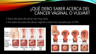 ¿QUÉ DEBO SABER ACERCA DEL
CÁNCER VAGINAL O VULVAR?
• Estos dos tipos de cáncer son muy raros.
• No todos los casos de cáncer vaginal o vulvar son causados por el VPH.
 