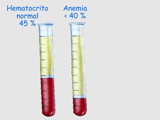 Hematocrito
normal
45 %
Anemia
< 40 %
 