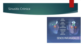 Sinusitis Crónica
 
