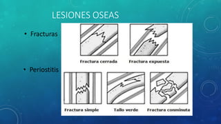 • Fracturas
• Periostitis
LESIONES OSEAS
 