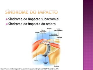Síndrome do ImpactoSíndrome do impacto subacromialSíndrome do impacto do ombrohttp://www.medicinageriatrica.com.br/wp-content/uploads/2007/08/ombro2.JPG