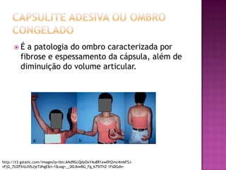 Capsulite adesiva ou Ombro congeladoÉ a patologia do ombro caracterizada por fibrose e espessamento da cápsula, além de diminuição do volume articular.http://t3.gstatic.com/images?q=tbn:ANd9GcQdyOxY4u8R1xw0ft2mc4m6F5J-vFjG_7UZPXiUJVbJjeTdhgE&t=1&usg=__0OJbwBG_Fg_k75ITIiZ-1FsDGds=