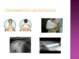 Tratamento ortopédico