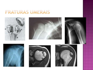 Fraturas umerais