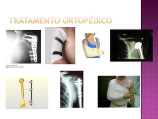 Tratamento ortopédico