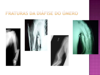 Fraturas da diáfise do úmero