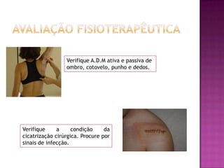 Avaliação fisioterapêuticaVerifique A.D.M ativa e passiva de ombro, cotovelo, punho e dedos.Verifique a condição da cicatrização cirúrgica. Procure por sinais de infecção.