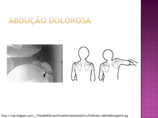 Abdução dolorosahttp://3.bp.blogspot.com/__F7zUqR4W2k/Sed1FuaX5HI/AAAAAAAACfI/pTrIViPxAEc/s400/000image010.jpg