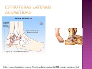 Estruturas Laterais Acometidashttp://www.clinicadeckers.com.br/html/orientacoes/ortopedia/034_entorse_tornozelo.html