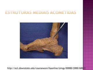 Estruturas Mediais Acometidashttp://ect.downstate.edu/courseware/haonline/simgs/00000/2000/600/2695.jpg