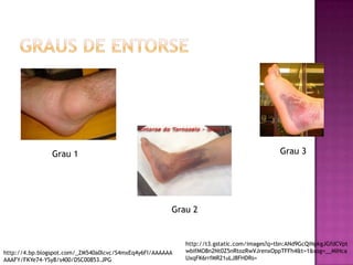 Graus de EntorseGrau 3Grau 1Grau 2http://t3.gstatic.com/images?q=tbn:ANd9GcQiNpkgJGfdCVptwbIfMO8n2Nt0Z5nRtozRwVJrenxOppTFFh4&t=1&usg=__MIHcaUxqFK6rrfMR21uLJ8FHDRs=http://4.bp.blogspot.com/_ZM540a0lcvc/S4mxEq4y6FI/AAAAAAAAAFY/FKYe74-YSy8/s400/DSC00853.JPG