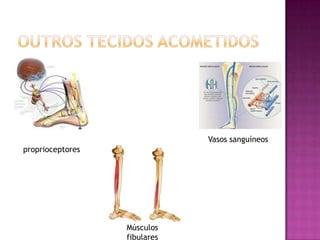 Outros tecidos acometidosVasos sanguíneosproprioceptoresMúsculos fibulares