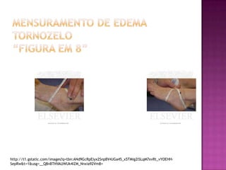 Mensuramento de Edema tornozelo“figura em 8”http://t1.gstatic.com/images?q=tbn:ANd9GcRpEiyx2SnpBV4JGa45_x5TMig2lSLqM7xvRt_vYOEHH-SepRw&t=1&usg=__Q8nBTNVAUWUk4IZM_Nnxia92Vm8=