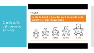 Clasificación
del quemado
en niños
 