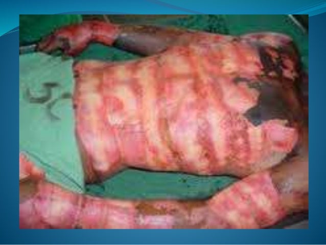 Fisioterapia en pacientes con quemaduras Fisioterapia en pacientes con quemaduras