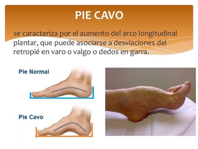 FISIOTERAPIA EN PIE CAVO PDF