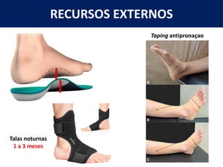 RECURSOS EXTERNOS
Talas noturnas
1 a 3 meses
Taping antipronaçao
 