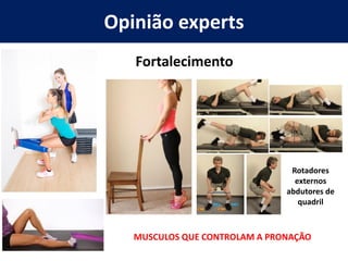 Opinião experts
Fortalecimento
Rotadores
externos
abdutores de
quadril
MUSCULOS QUE CONTROLAM A PRONAÇÃO
 