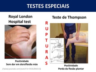 TESTES ESPECIAIS
Teste de Thompson
R
U
P
T
U
R
A
S
//www.youtube.com/watch?v=VEOL0tX2rcQ
Royal London
Hospital test
Positividade
Sem dor em dorsiflexão máx Positividade
Perda da flexão plantar
 