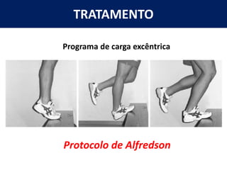 TRATAMENTO
Protocolo de Alfredson
Programa de carga excêntrica
 