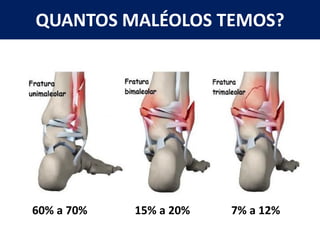 QUANTOS MALÉOLOS TEMOS?
60% a 70% 15% a 20% 7% a 12%
 