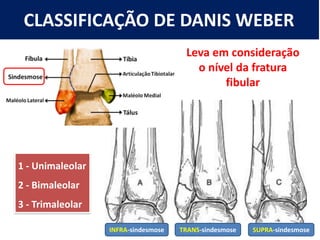 CLASSIFICAÇÃO DE DANIS WEBER
Leva em consideração
o nível da fratura
fibular
1 - Unimaleolar
2 - Bimaleolar
3 - Trimaleolar
INFRA-sindesmose TRANS-sindesmose SUPRA-sindesmose
 