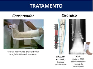 TRATAMENTO
Conservador
Fraturas maleolares extra-articular
SEM/MÍNIMO deslocamento
RAFI
Fraturas COM
deslocamento ou
ruptura da
SINDESMOSE
Cirúrgico
FIXADOR
EXTERNO
lesão de
tecidos moles
 