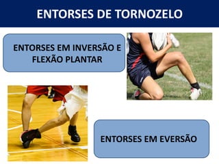 ENTORSES DE TORNOZELO
ENTORSES EM INVERSÃO E
FLEXÃO PLANTAR
ENTORSES EM EVERSÃO
 