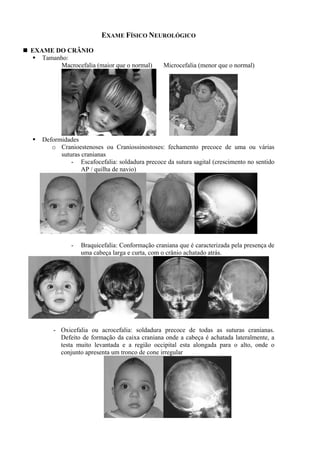 EXAME FÍSICO NEUROLÓGICO
EXAME DO CRÂNIO
Tamanho:
Macrocefalia (maior que o normal) Microcefalia (menor que o normal)
Deformidades
o Cranioestenoses ou Craniossinostoses: fechamento precoce de uma ou várias
suturas cranianas
- Escafocefalia: soldadura precoce da sutura sagital (crescimento no sentido
AP / quilha de navio)
- Braquicefalia: Conformação craniana que é caracterizada pela presença de
uma cabeça larga e curta, com o crânio achatado atrás.
- Oxicefalia ou acrocefalia: soldadura precoce de todas as suturas cranianas.
Defeito de formação da caixa craniana onde a cabeça é achatada lateralmente, a
testa muito levantada e a região occipital esta alongada para o alto, onde o
conjunto apresenta um tronco de cone irregular
 