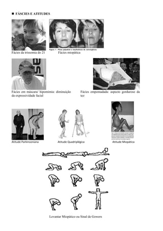 FÁSCIES E ATITUDES
Fácies da trissomia do 21 Fácies miopática
Fácies em máscara/ hipomimia: diminuição
da expressividade facial
Fácies empomadada: aspecto gorduroso da
tez
                                                       
Atitude Parkinsoniana                            Atitude Quadriplégica                                         Atitude Miopática 
 
Levantar Miopático ou Sinal de Gowers
 