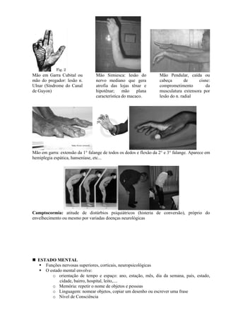  
Mão em Garra Cubital ou
mão do pregador: lesão n.
Ulnar (Síndrome do Canal
de Guyon)
Mão Simiesca: lesão do
nervo mediano que gera
atrofia das lojas tênar e
hipotênar; mão plana
característica do macaco.
Mão Pendular, caída ou
cabeça de cisne:
comprometimento da
musculatura extensora por
lesão do n. radial
 
Mão em garra: extensão da 1° falange de todos os dedos e flexão da 2° e 3° falange. Aparece em
hemiplegia espática, hanseníase, etc...
Camptocormia: atitude de distúrbios psiquiátricos (histeria de conversão), próprio do
envelhecimento ou mesmo por variadas doenças neurológicas
ESTADO MENTAL
Funções nervosas superiores, corticais, neuropsicológicas
O estado mental envolve:
o orientação de tempo e espaço: ano, estação, mês, dia da semana, país, estado,
cidade, bairro, hospital, leito,....
o Memória: repetir o nome de objetos e pessoas
o Linguagem: nomear objetos, copiar um desenho ou escrever uma frase
o Nível de Consciência
 