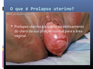 O que é Prolapso uterino?
 Prolapso uterino é a queda ou deslizamento
do útero da sua posição normal para a área
vaginal.
 