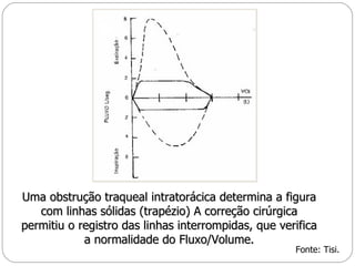 Uma obstrução traqueal intratorácica determina a figura com linhas sólidas (trapézio) A correção cirúrgica permitiu o registro das linhas interrompidas, que verifica a normalidade do Fluxo/Volume. Fonte: Tisi. 
