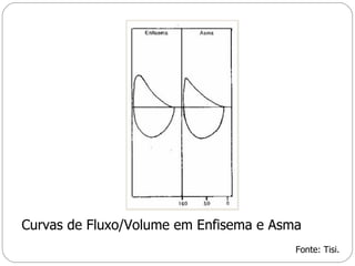 Curvas de Fluxo/Volume em Enfisema e Asma Fonte: Tisi. 