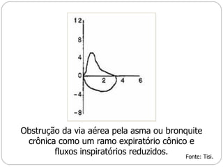 Obstrução da via aérea pela asma ou bronquite crônica como um ramo expiratório cônico e fluxos inspiratórios reduzidos. Fonte: Tisi. 