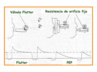 Fisioterapia respiratoria uci . lobitoferoz13 | PPT